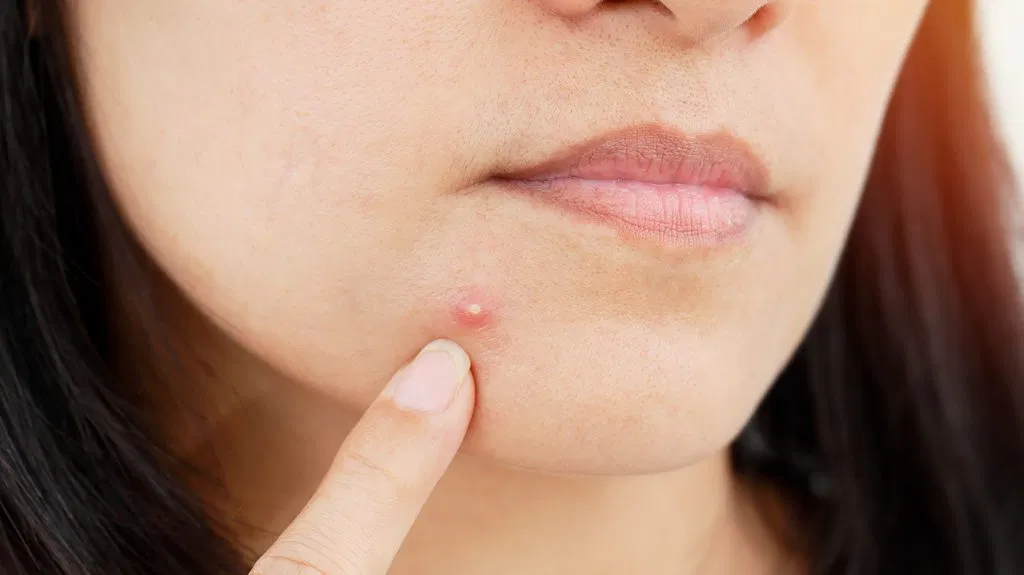 SR Clinic Pimples Treatments